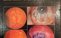 The eye in systemic disease